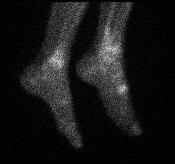 Second MT Stress Fracture Bone Scan